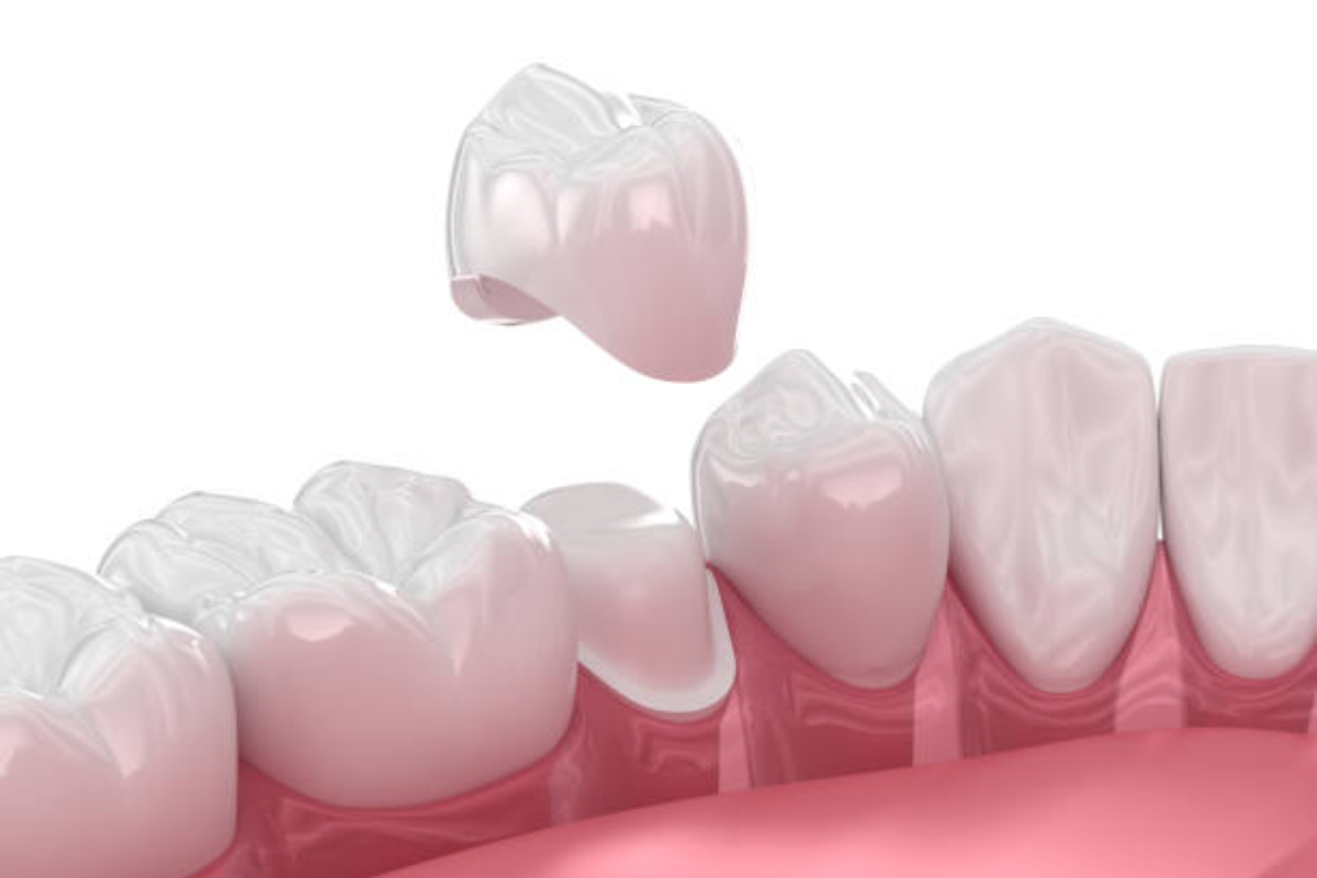 dental crowns 101: which type is right for you?